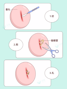 男生结扎vs女生结扎，该谁来做？！