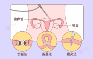 男生结扎vs女生结扎，该谁来做？！