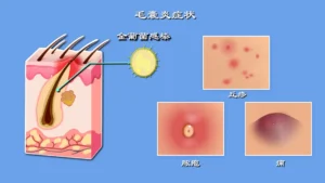 私处长痘痘是怎么回事？了解正确处理方式