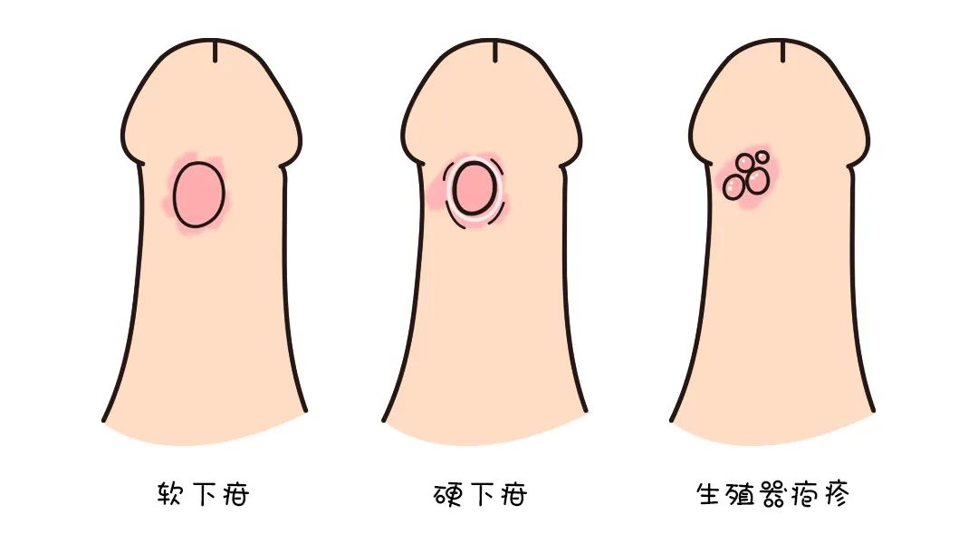 啪都啪了，怎么知道自己有没有感染【性病】？