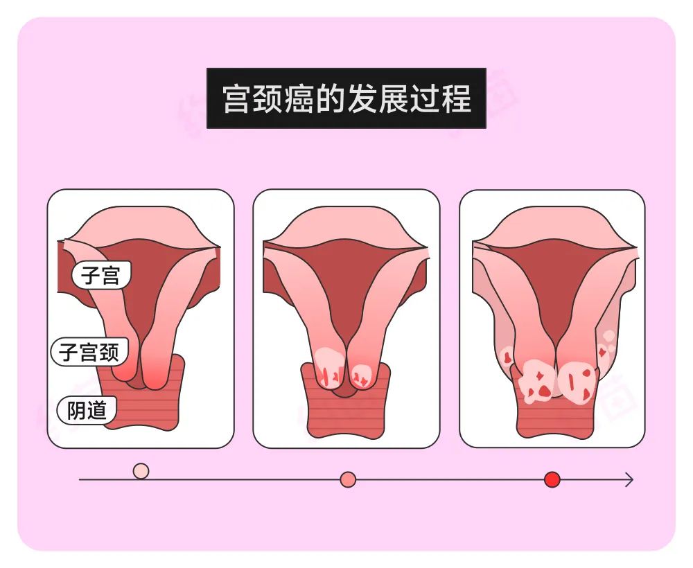 当女生染上HPV，上厕所就能看出来？注意 3 个小信号→